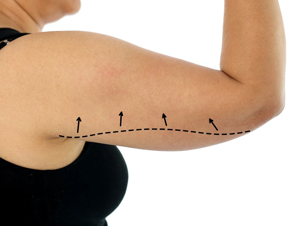 3 Non-Surgical Treatments for flabby arms The Éterne Clinic