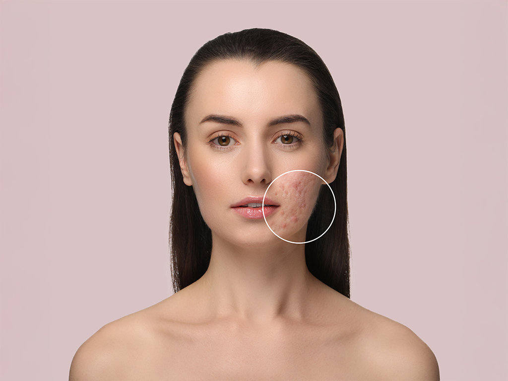 How to Treat Acne Scars Effectively: Dermatologist-Approved Solutions in Mumbai 