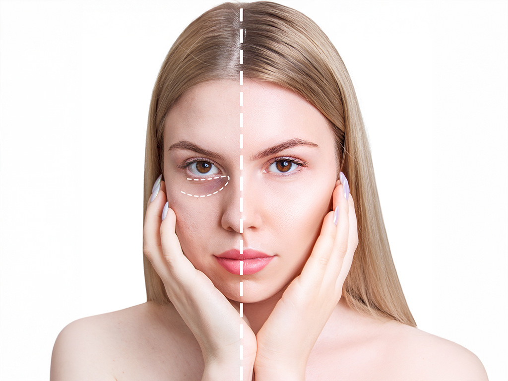 Under Eye Dark Circle Treatment in Mumbai: Causes, Concerns & The Best Solutions That Actually Work 