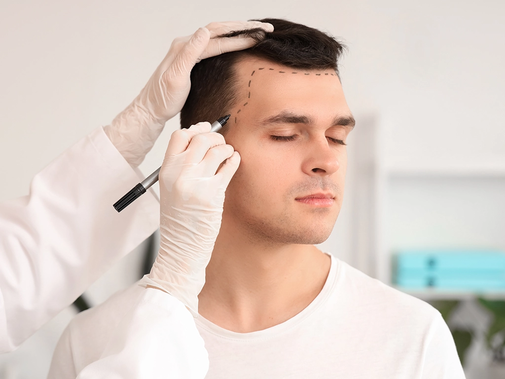 Why FAAST™ is Better Than FUE and FUT Hair Transplants?