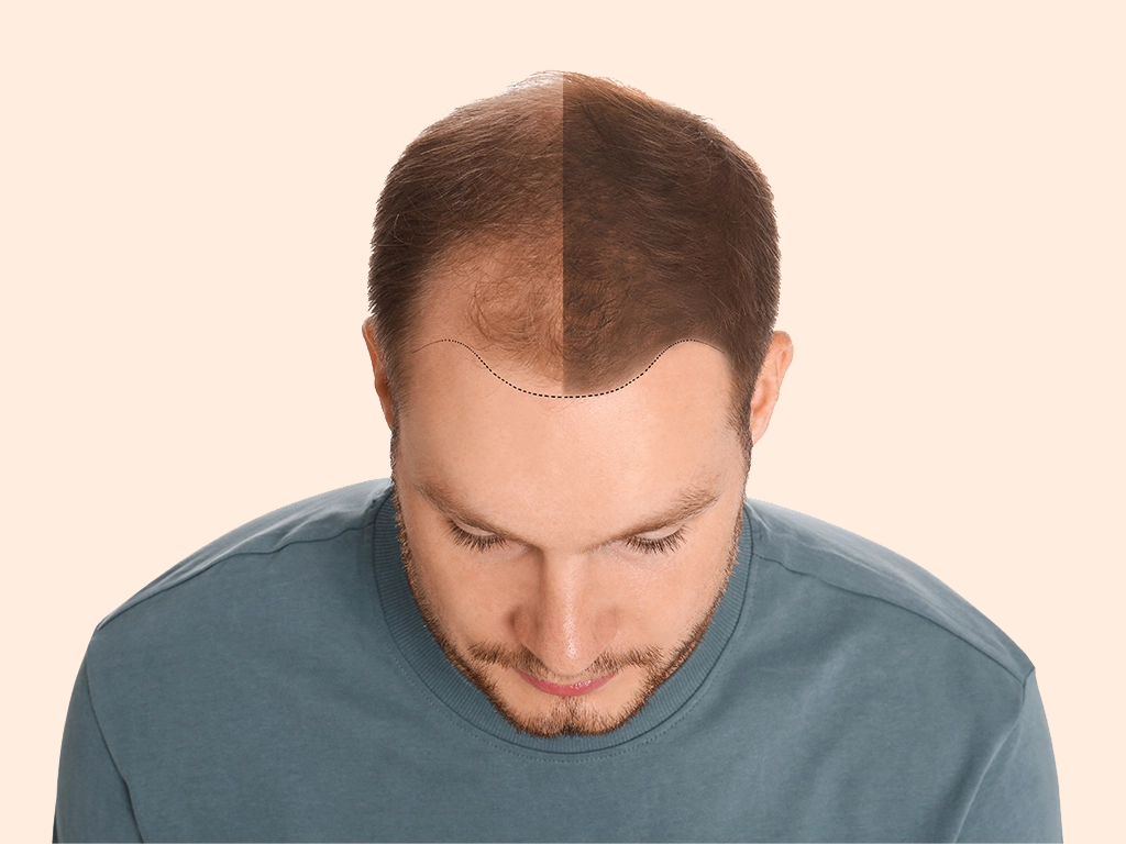 Hair Transplant Recovery Timeline & What to Expect