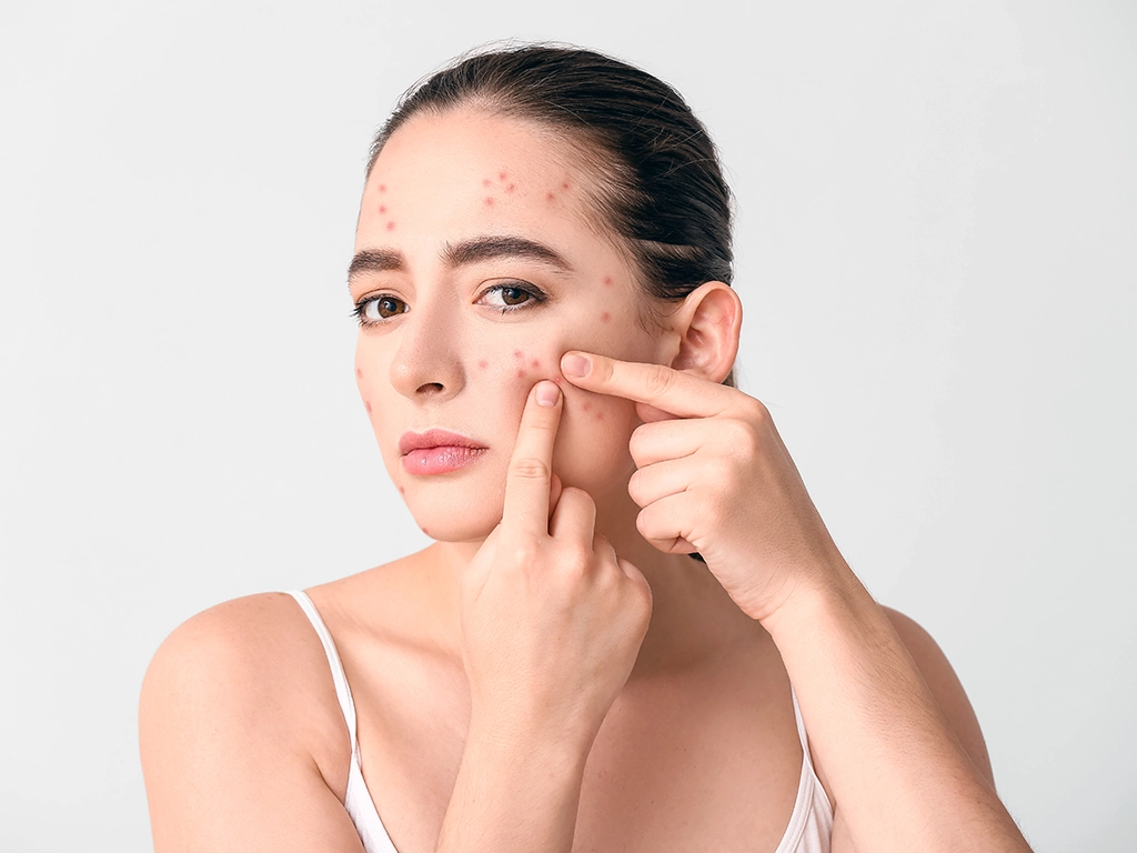 Hormonal Acne and Diet: What Your Skin’s Trying to Tell You