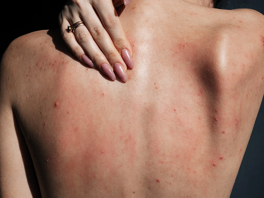 5 Targeted Back Acne Treatments 