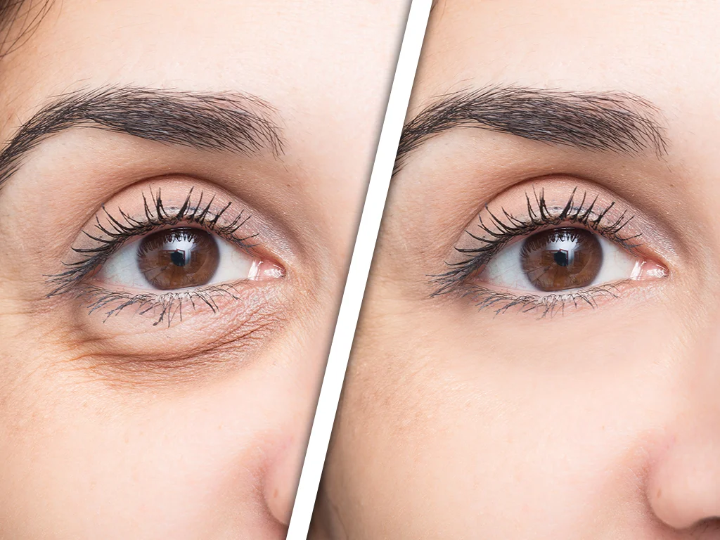 Banishing Under Eye Bags: 3 Treatments for a Fresher Look 