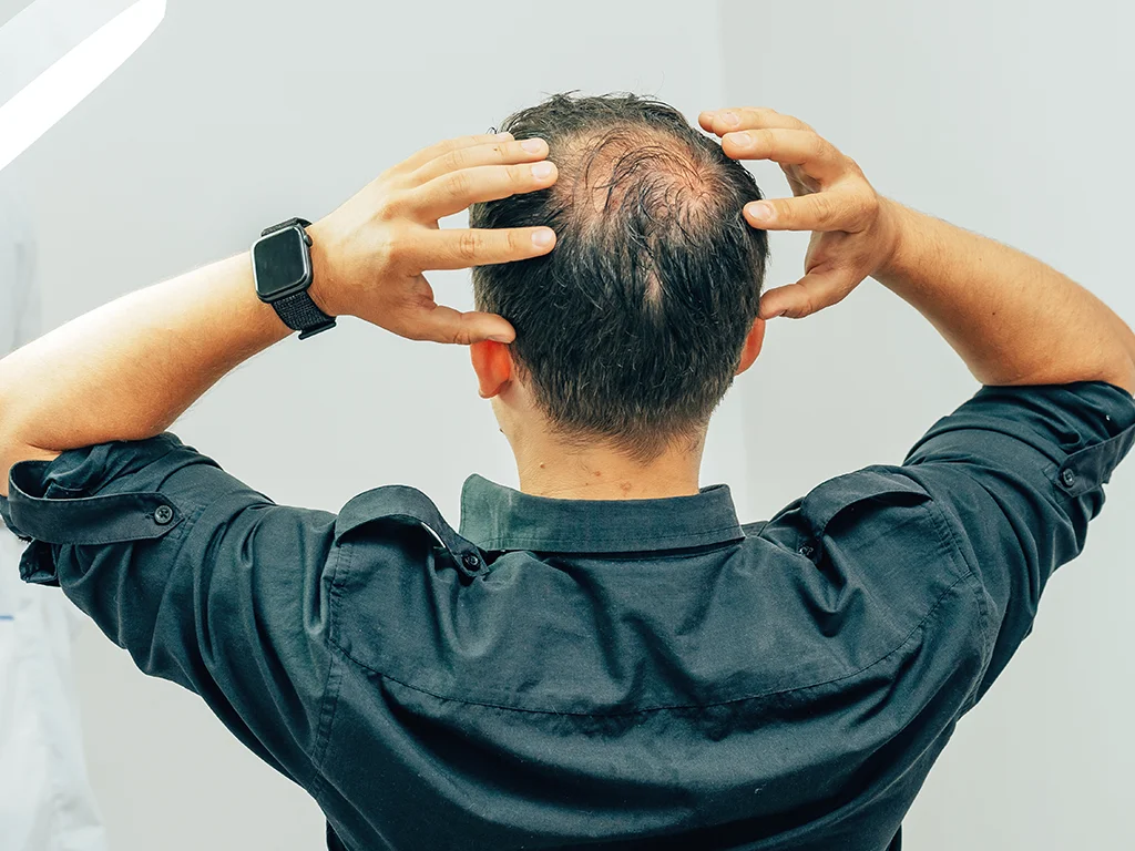 5 Things That Can Go Wrong with a Hair Transplant