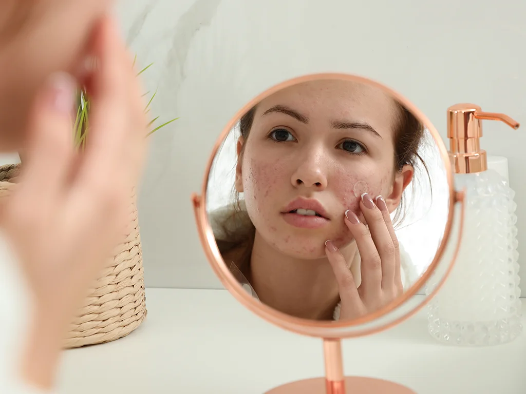 Do Pimple Patches Work? Everything You Need to Know 