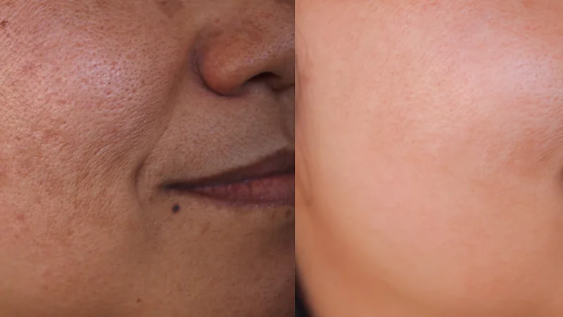 Body Pigmentation Treatments at The Éterne Clinic