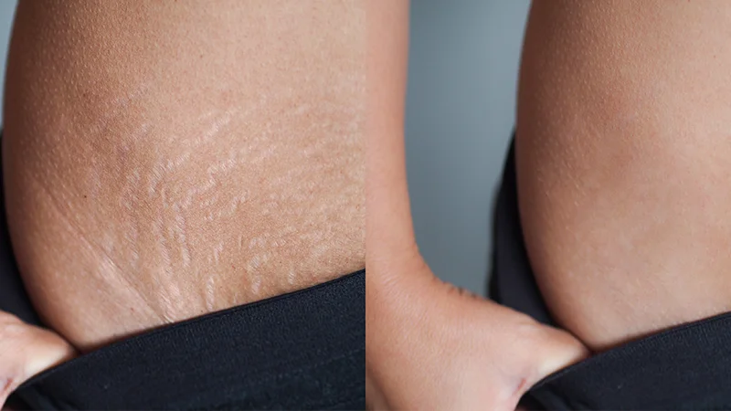 Best Treatment for Stretch Marks at The Éterne Clinic