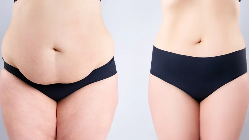 Eliminate stubborn body fat at The Éterne Clinic