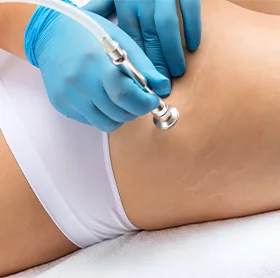 Best Treatment for Stretch Marks at The Éterne Clinic