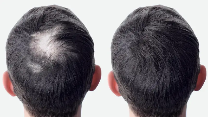 Alopecia areata Treatments at The Éterne Clinic