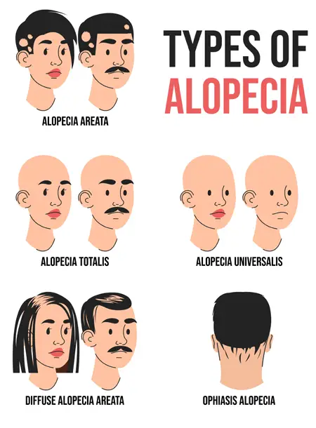 Alopecia areata Treatments at The Éterne Clinic