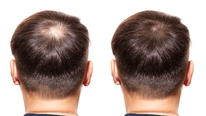 Hair Loss Treatments at The Éterne Clinic