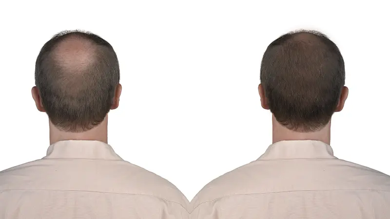 Male Pattern Baldness Treatments at The Éterne Clinic