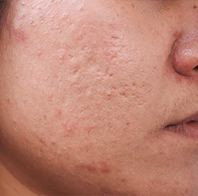 Acne Scars & Marks Treatments at The Éterne Clinic