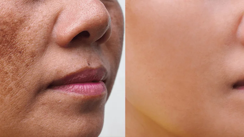 Anti-Pigmentation Treatments at The Éterne Clinic