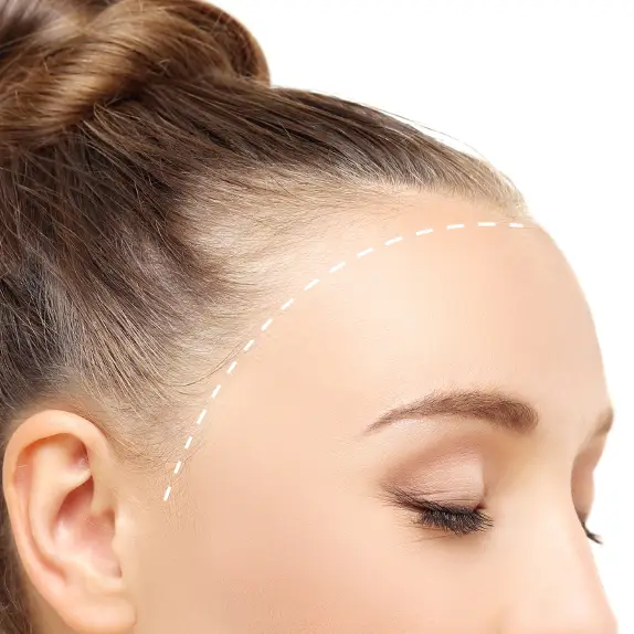 Long hair transplant traction alopecia