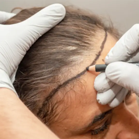 Fue hair transplant for women