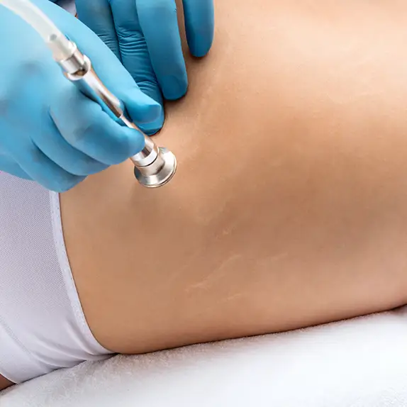 Stretch Marks
                                    Treatments at The Éterne Clinic